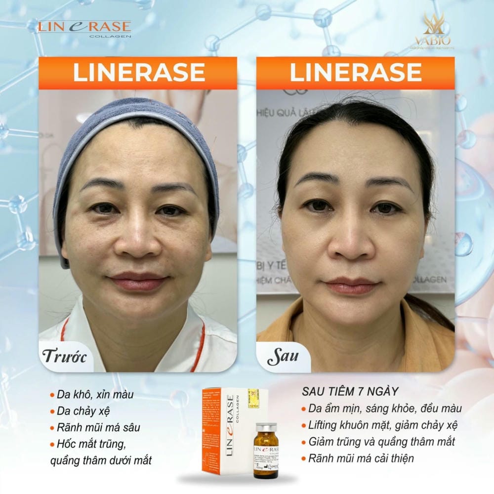 Linerase có bằng chứng lâm sàng không — kết quả thực tế kéo dài bao lâu?