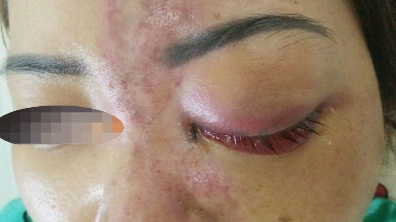 So sánh nguy cơ: filler HA (Hyaluronic Acid) và các chất làm đầy khác