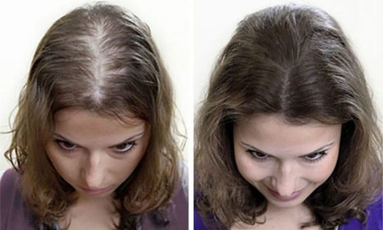 2. Thuốc uống nội tiết/thuốc tác động hệ androgen