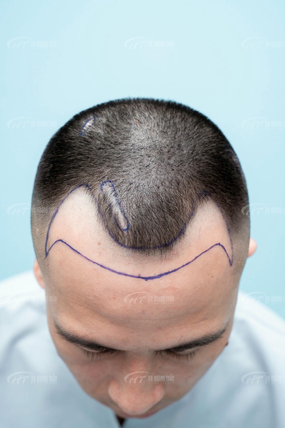 Giải pháp che khuyết thẩm mỹ