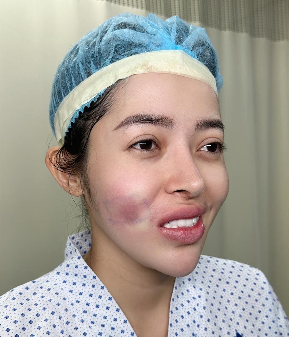 Quy trình bước — nếu nghi ngờ tắc mạch filler sau tiêm, cần làm gì trước tiên?