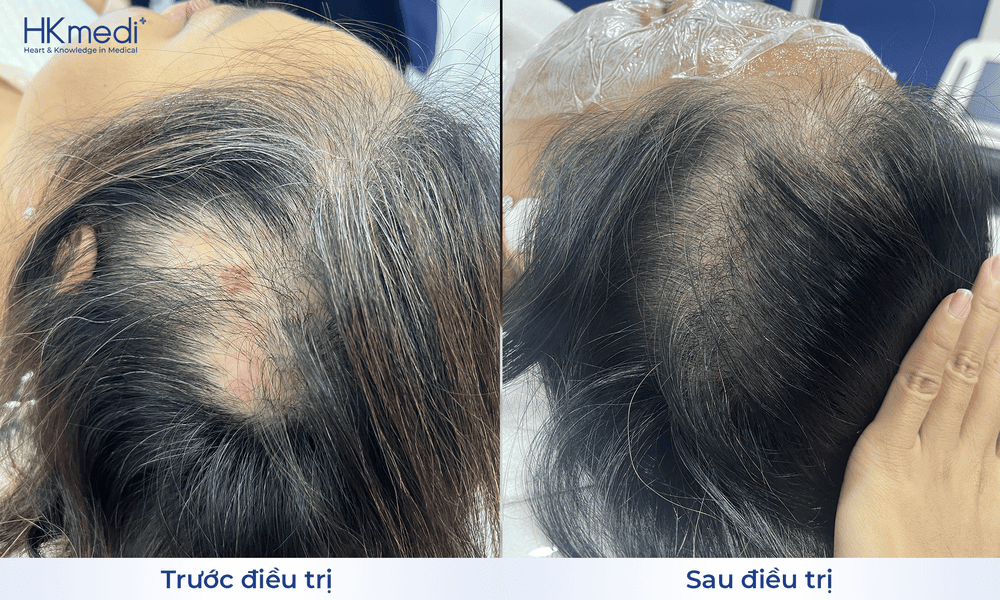 Các phương pháp điều trị phổ biến — hiệu quả và rủi ro là gì?
