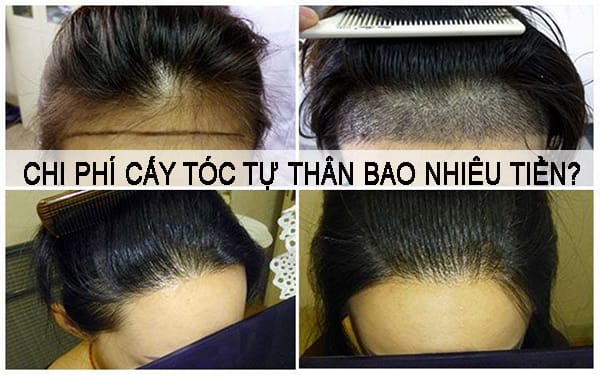 PRP hay cấy tóc — nên chọn gì trước?