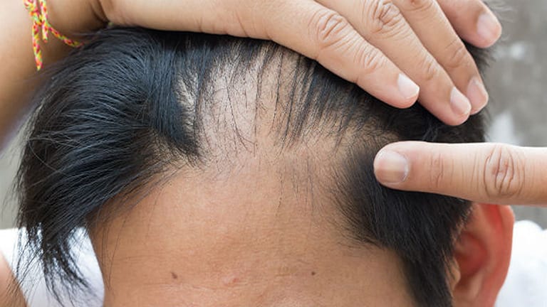 Khi nào rụng tóc nam trở nên cần phải đi khám?