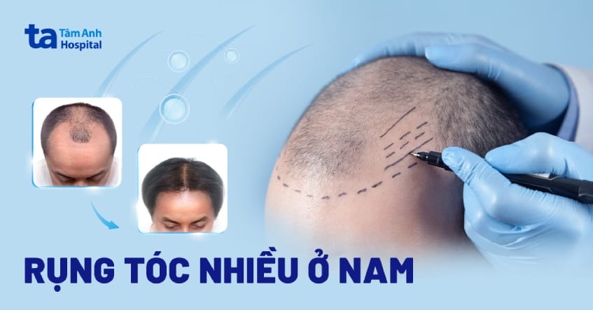 Bác sĩ sẽ hỏi và kiểm tra những gì trong một buổi khám rụng tóc nam?