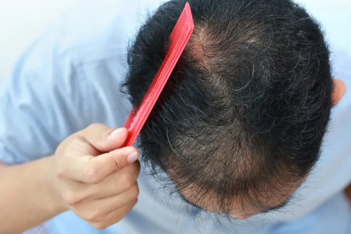 Những phương pháp điều trị rụng tóc nam nào có bằng chứng tốt — và tác dụng phụ cần biết?