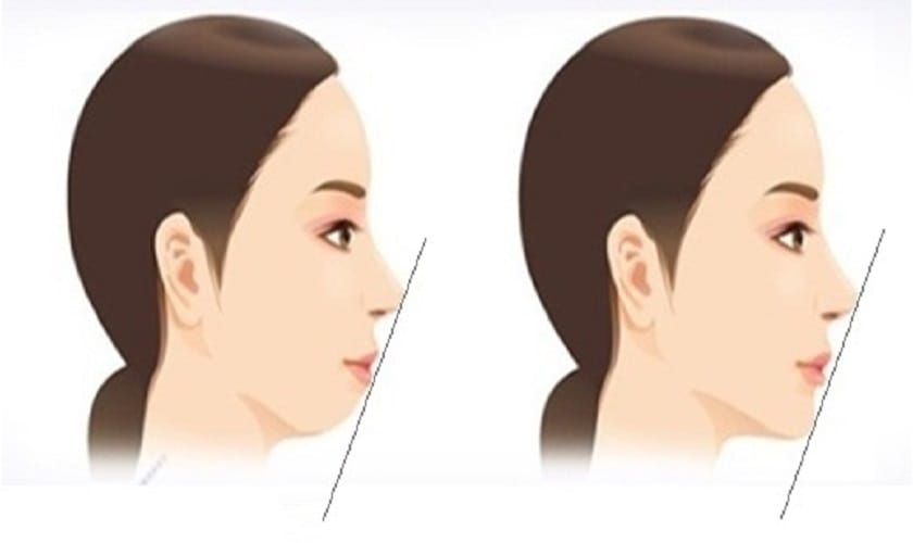 Tiêm filler có sửa được cằm lẹm không — và nên chọn filler nào?