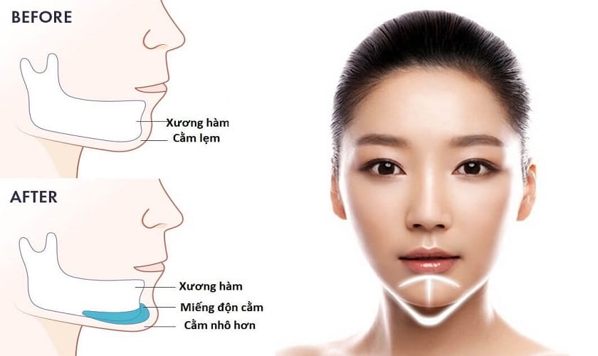 Phẫu thuật độn cằm, genioplasty hay đặt implant — khi nào cần phải mổ?