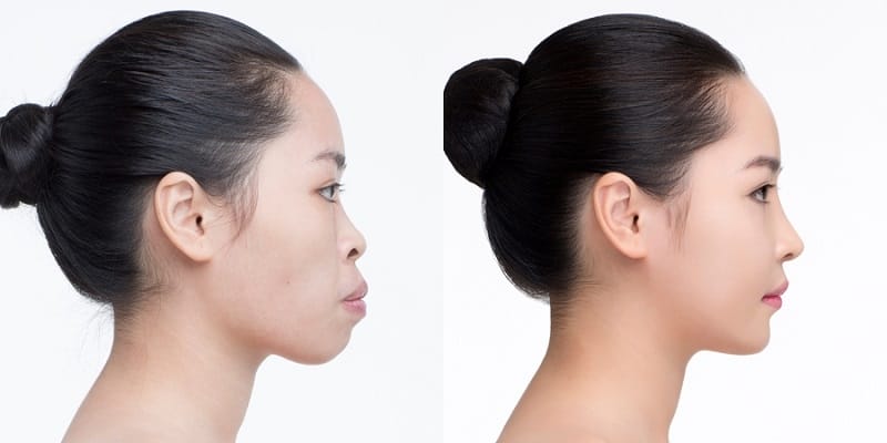 Chi phí tham khảo và lựa chọn cơ sở uy tín