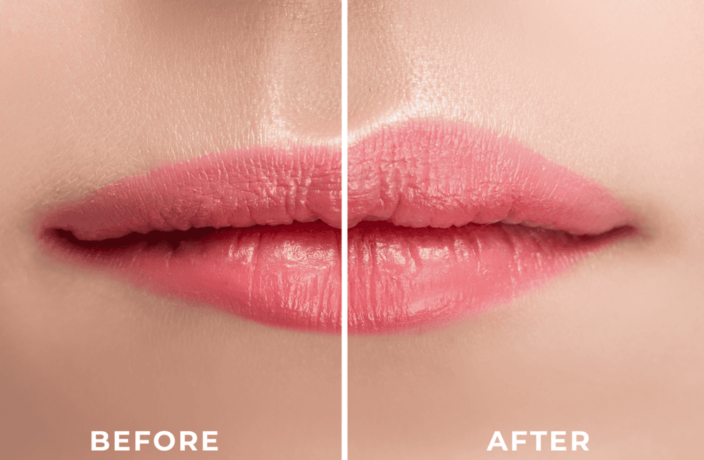 Tiêm filler môi có đau không, và kết quả giữ được trong bao lâu?