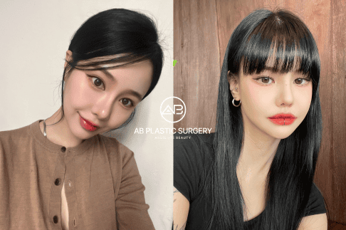 Ai không nên tiêm filler môi ngay bây giờ?