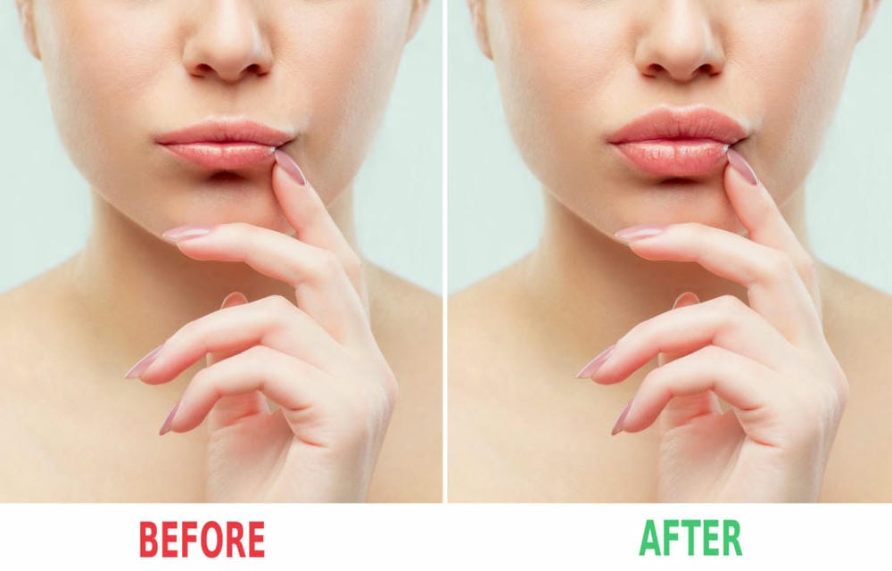 Làm sao để chọn nơi tiêm filler an toàn và uy tín?