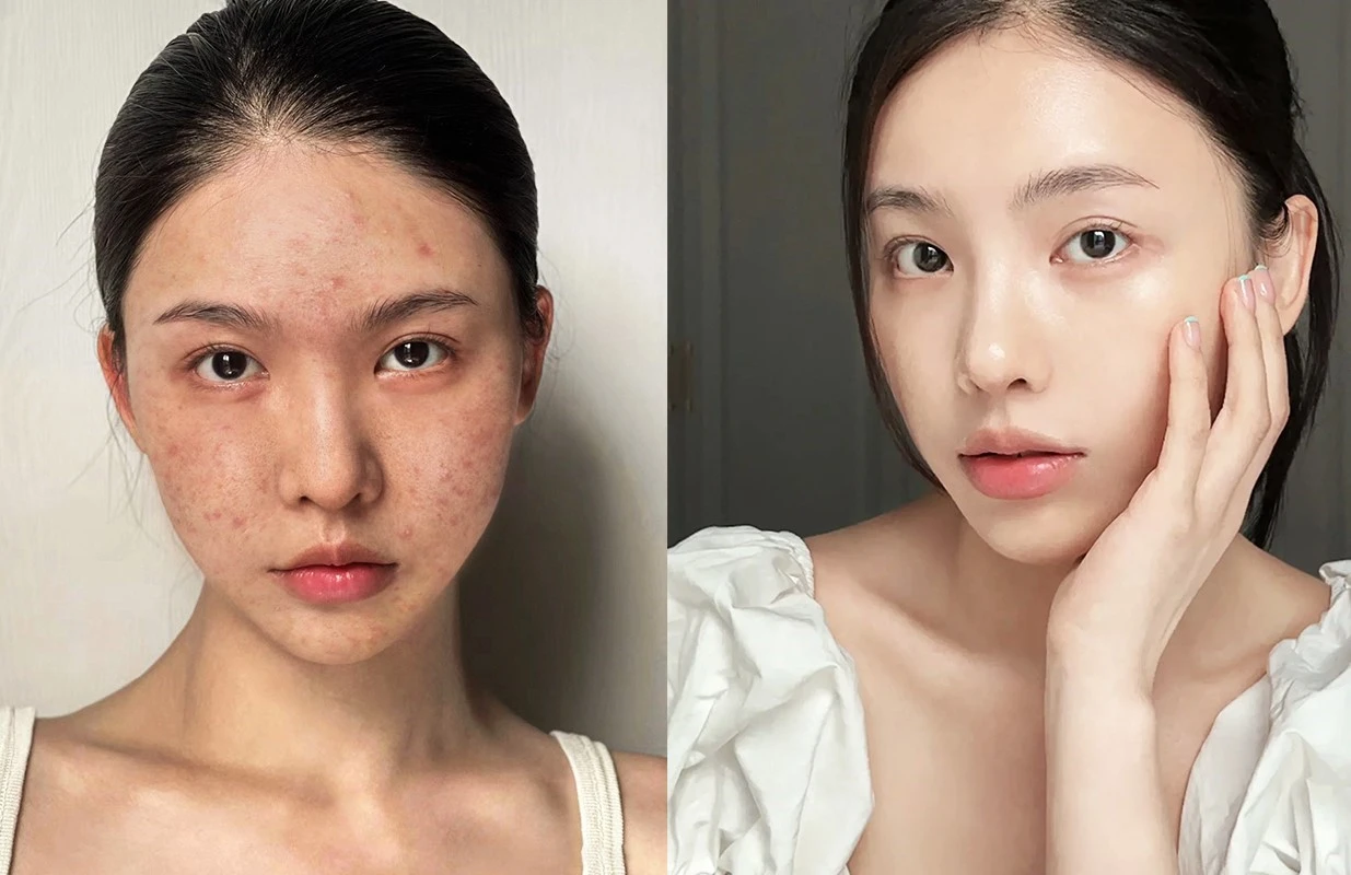 Bằng chứng lâm sàng về trẻ hóa da và sẹo rỗ