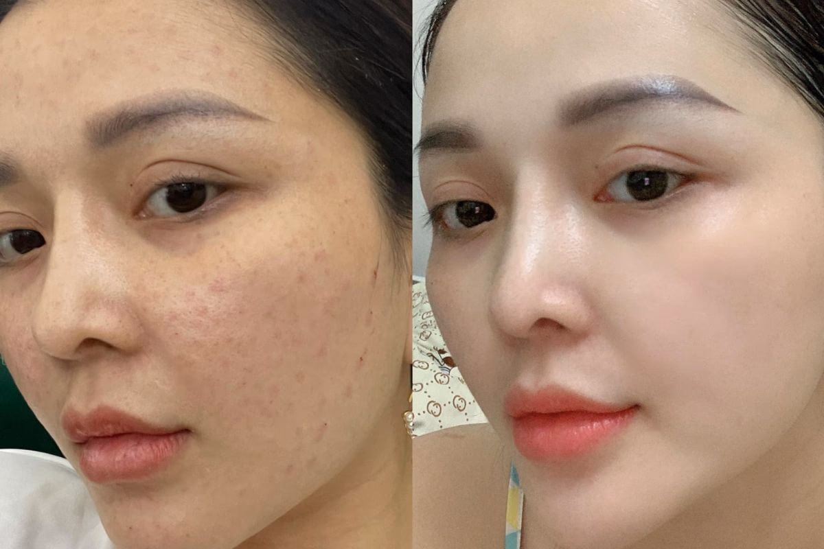 Bạn cần biết những rủi ro và tác dụng phụ nào?