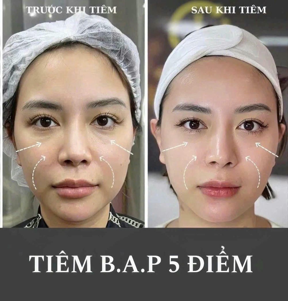 Hiệu quả khoa học của Profhilo có rõ ràng?