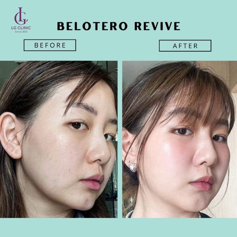 Quy trình kỹ thuật tiêm (thực hiện bởi bác sĩ được đào tạo)