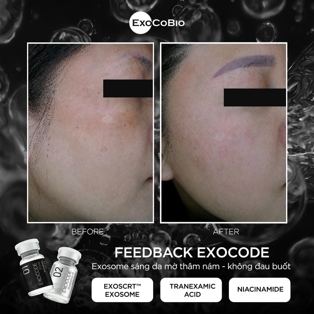 So sánh tiêm Exocode với phương pháp khác — nên chọn gì cho từng vấn đề?