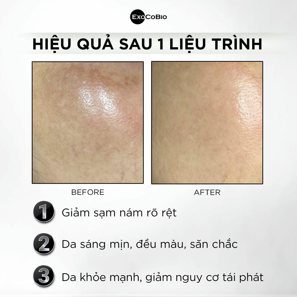 Kết quả thấy ngay không và duy trì được bao lâu?