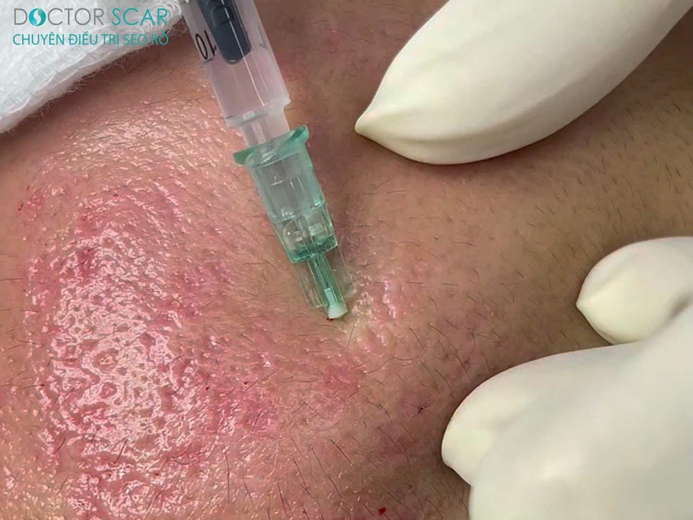 Exosome so với PRP, tế bào gốc và mesotherapy — Nên chọn phương pháp nào?