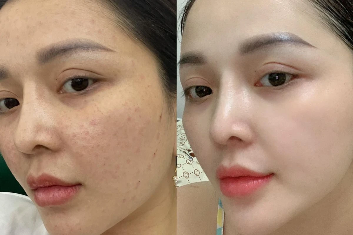 Kết quả nhìn thấy sau bao lâu và kéo dài được bao lâu?