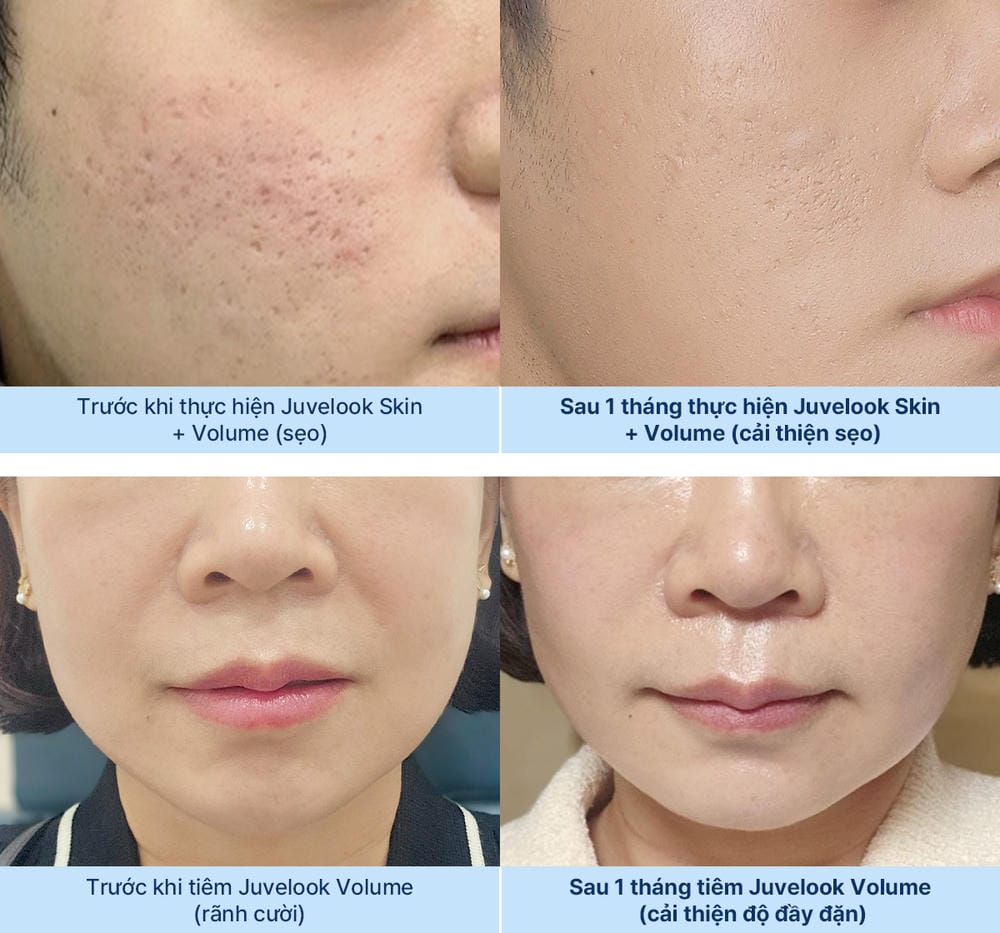 Chăm sóc sau tiêm và những lưu ý giúp tối ưu kết quả