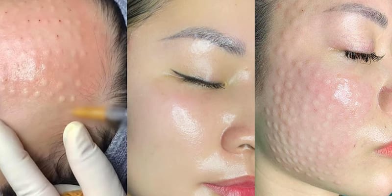 Hiệu quả của tiêm meso có được chứng minh bằng bằng chứng lâm sàng không?