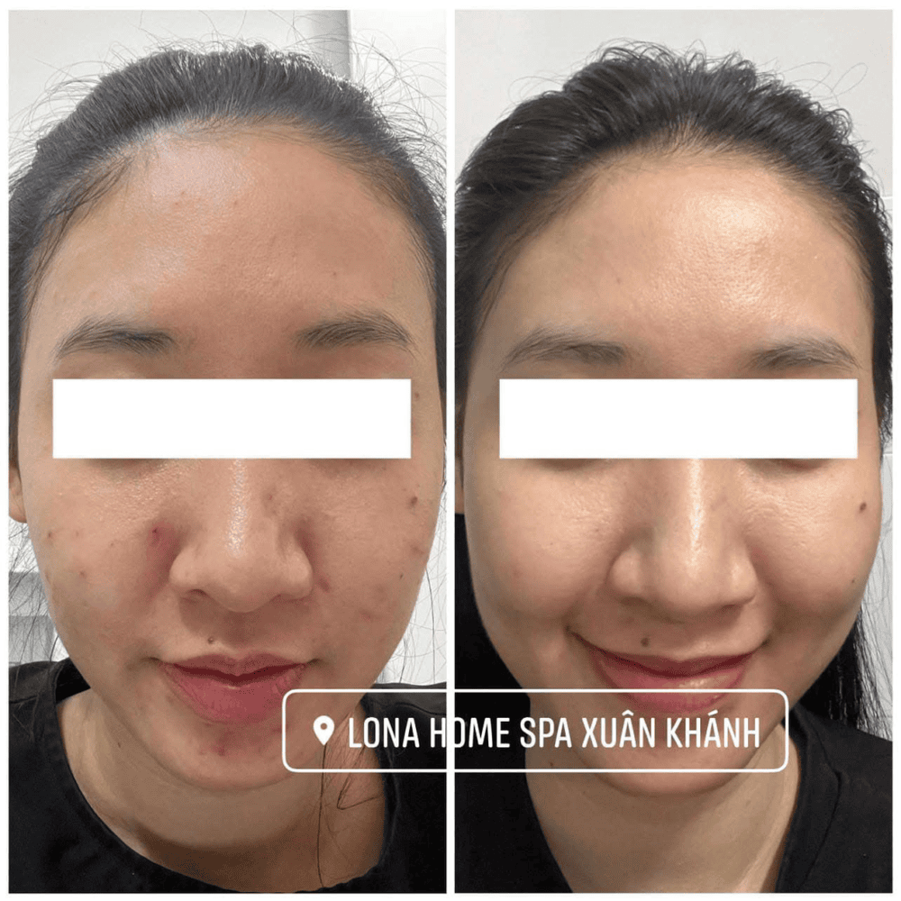 Ai phù hợp và ai không nên tiêm Mesoestetic?