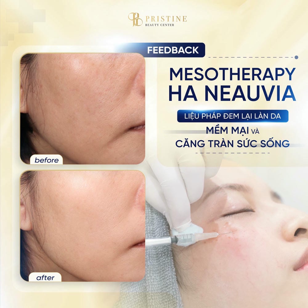 Tiêm Neauvia thực hiện như thế nào — quy trình chi tiết trước, trong và sau khi tiêm?