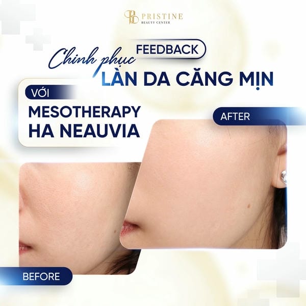 Tiêm Neauvia có nguy cơ gì — những tác dụng phụ và biến chứng cần lường trước?