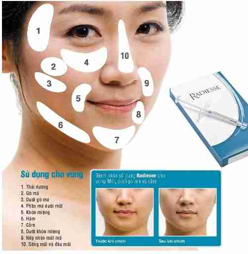Kết quả thường thấy sau khi tiêm Radiesse là gì và kéo dài bao lâu?