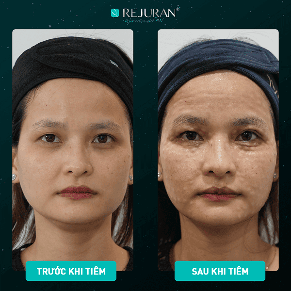 Cơ chế Rejuran tác động lên da ra sao — tại sao nó khác filler hay PRP?