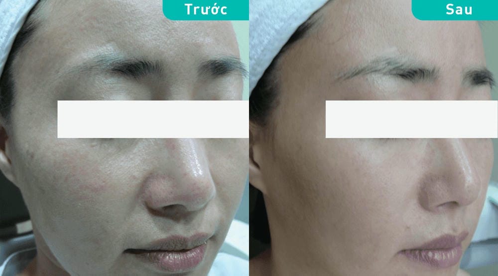 Nên so sánh Rejuran với các phương pháp khác như filler HA, PRP, hay mesotherapy như thế nào?