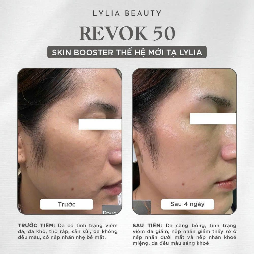 Chi phí Revok 50 và thời gian hồi phục