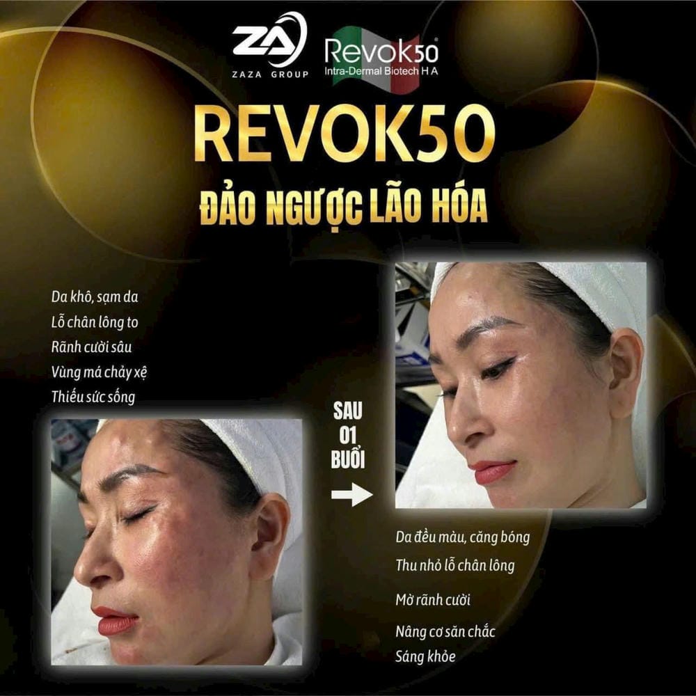 Revok 50 khác gì so với filler, Profhilo hay Rejuran?