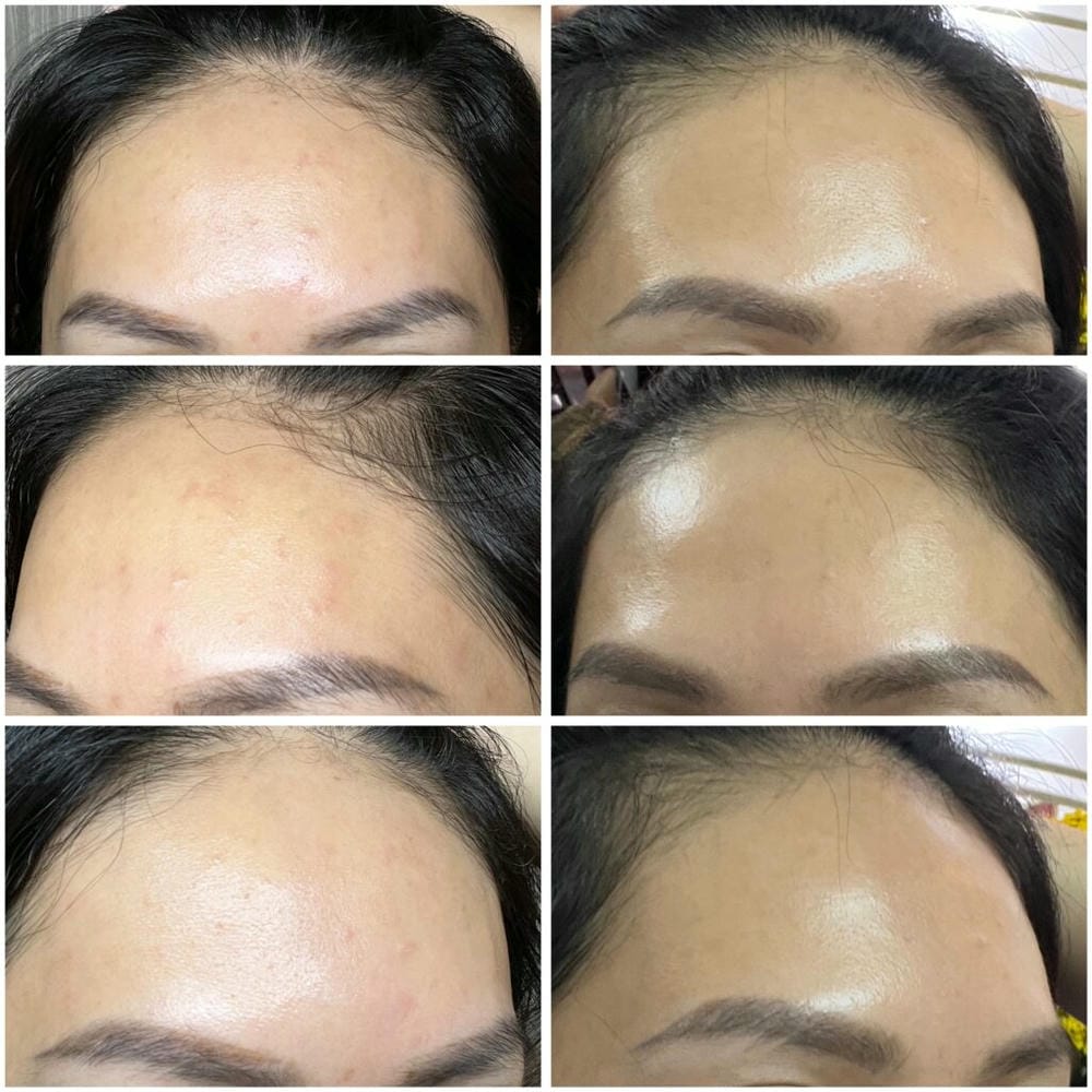 Có bằng chứng lâm sàng nào chứng minh hiệu quả và an toàn của Xeomin không?