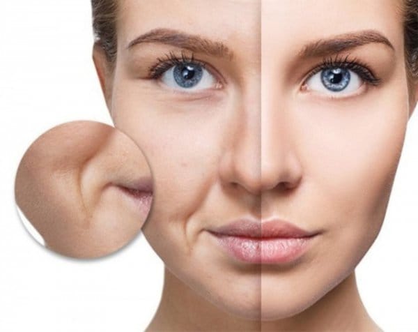 Can thiệp phẫu thuật nâng mô giữa mặt (midface lift) và nâng toàn phần