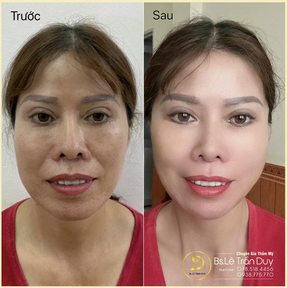 Tại sao rãnh cười xuất hiện — có thể “hết” được hoàn toàn không?