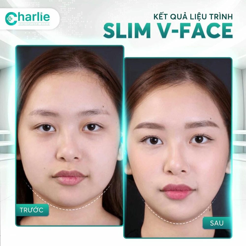 Tại sao hàm của một người lại trông to — do cơ, xương hay mỡ?