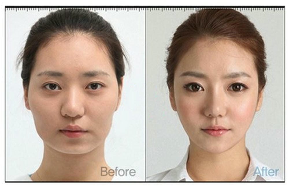 Tiêm botox cơ cắn có thật sự giúp làm thon gọn hàm không — cơ chế và hiệu quả kéo dài bao lâu?