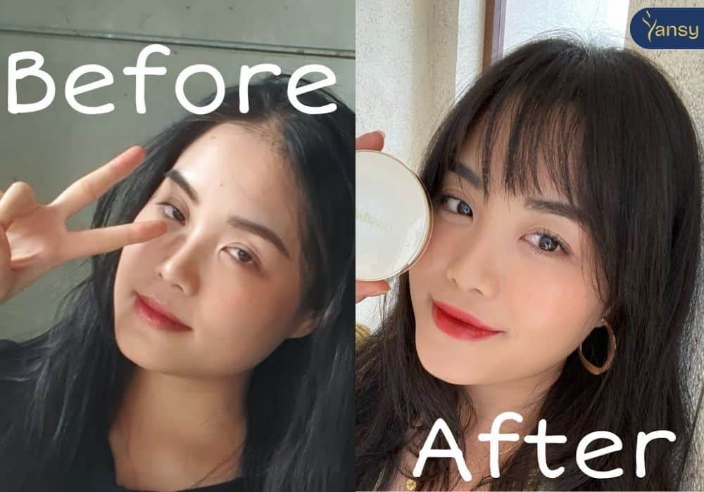 Phẫu thuật gọt góc hàm có cần thiết không — lợi ích và rủi ro so với tiêm?