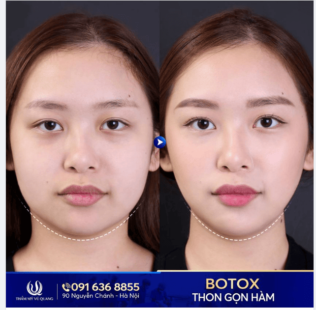 Ngoài Botox và phẫu thuật, còn có những lựa chọn nào khác để làm thon gọn hàm?
