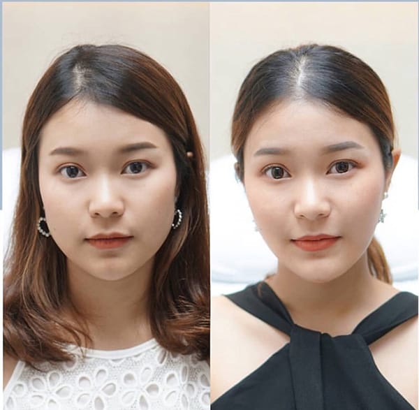 Ai phù hợp và ai không phù hợp với tiêm Botulinum toxin?