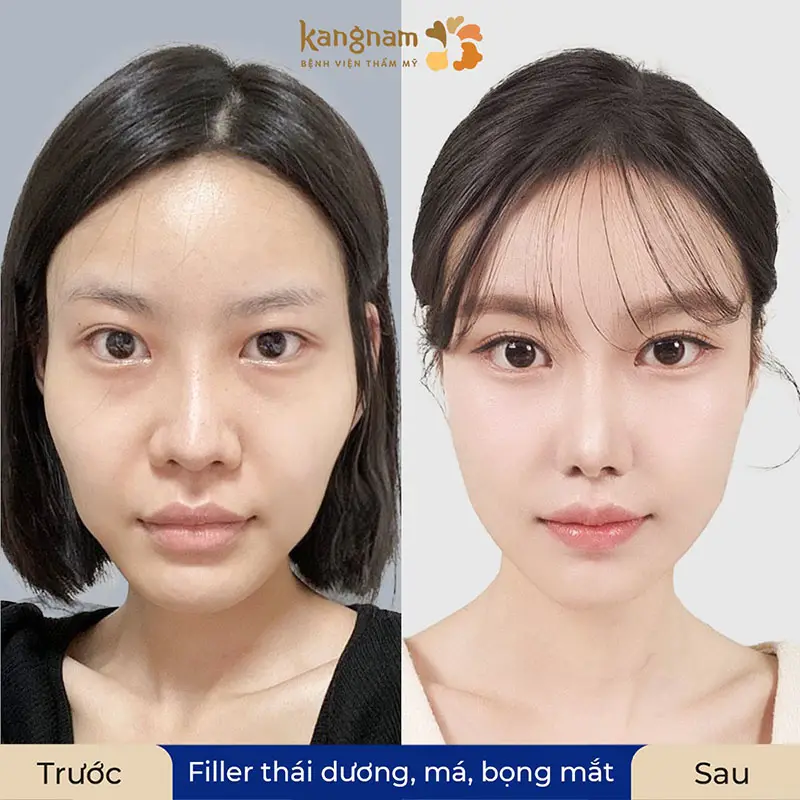 Filler nào phù hợp để làm đầy má — Vivacy, Opera, Aileene khác nhau thế nào và tại sao nên ưu tiên?