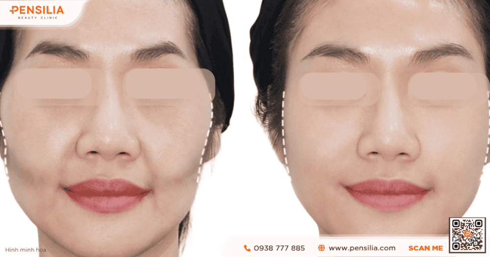 Chăm sóc sau tiêm và những lưu ý để có kết quả đẹp, tự nhiên