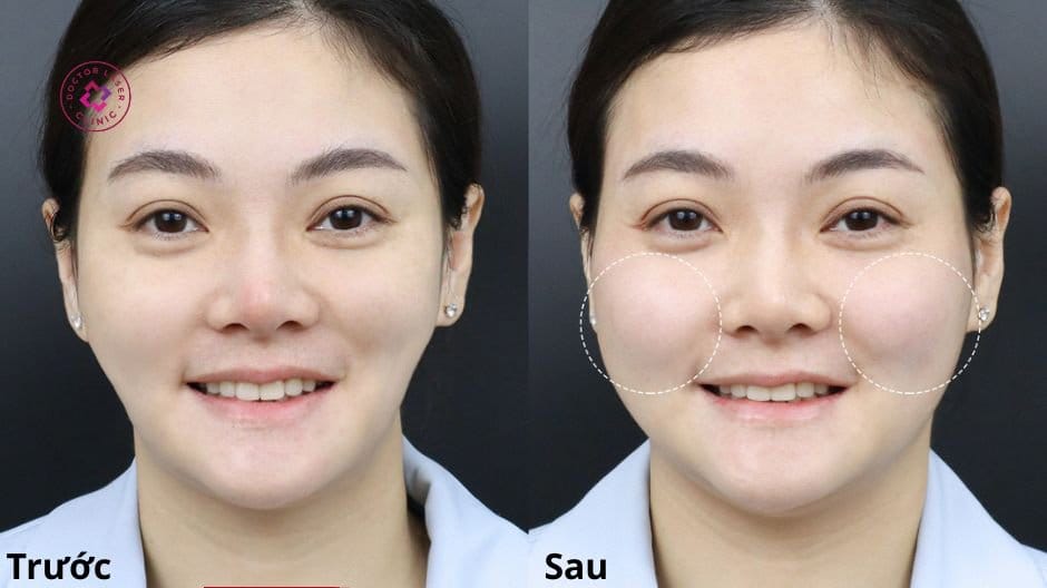 Nếu muốn làm đầy má bằng tiêm filler — bước tiếp theo nên là gì?