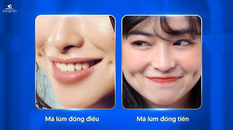 Lúm đồng điếu ở cằm là gì và cơ chế hình thành?