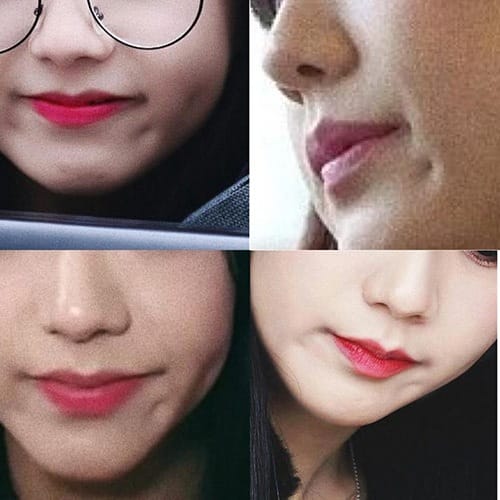 Tiêm Botox cơ cằm có giúp mịn cằm chẻ không?