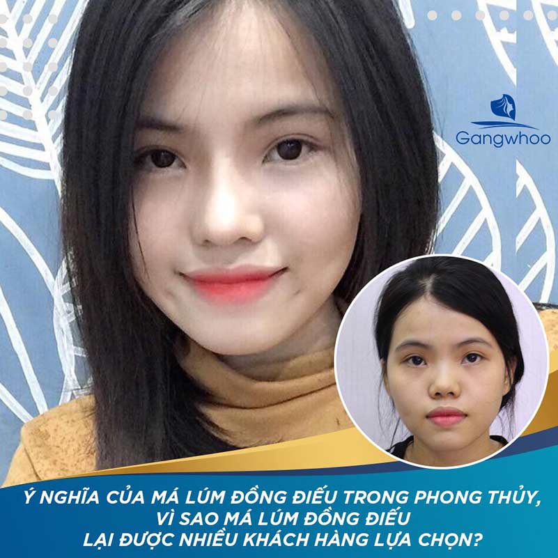 Subcision tách dính kết hợp filler — khi nào cần?