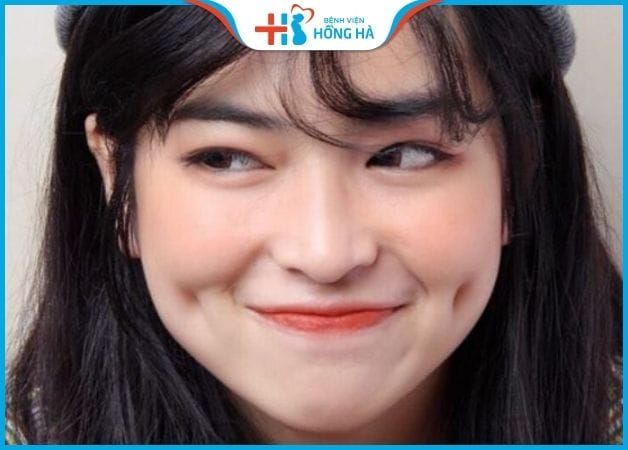Tiêm filler có làm mất biểu cảm tự nhiên của cằm không?