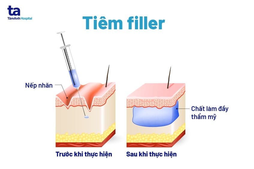 Cơ chế tác động của các loại filler — Hyaluronic acid (HA) khác gì với chất làm đầy kích thích collagen?
